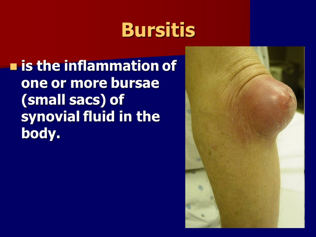Bursitis is the inflammation of one or more bursae (small sacs) of synovial fluid